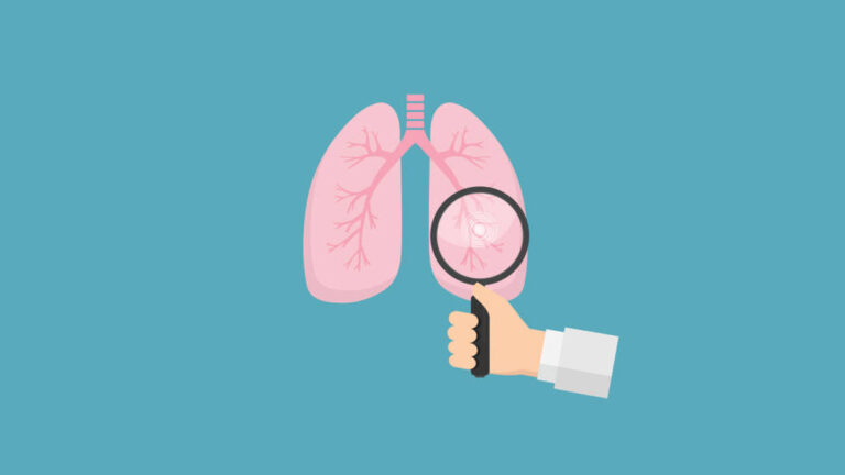 Program Wczesnego Wykrywania Raka Płuca – trwa rekrutacja